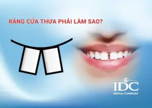 Răng cửa xấu phải làm sao? 7 Phương pháp giúp cải thiện nụ cười