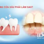 Răng cửa xấu phải làm sao?