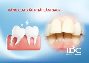 Răng hô có bọc sứ được không? Trường hợp nào nên và không nên bọc sứ?