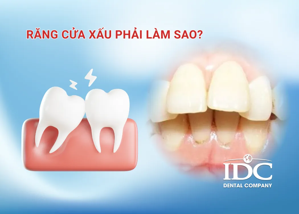 Răng cửa xấu phải làm sao?