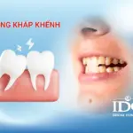 Răng khấp khểnh có ảnh hưởng đến sức khỏe răng miệng không?
