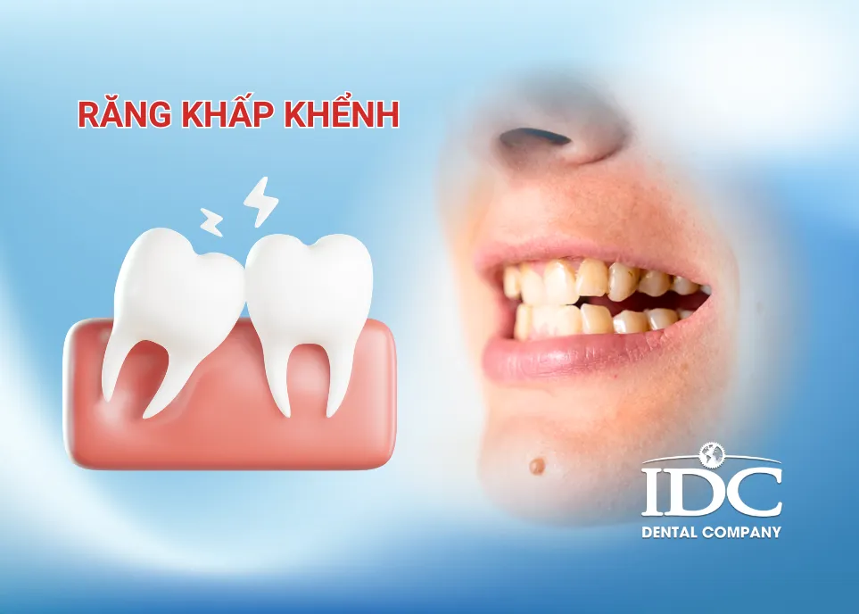 Răng khấp khểnh có ảnh hưởng đến sức khỏe răng miệng không?