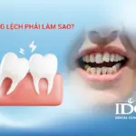 Răng lệch