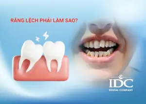Răng chen chúc có cần niềng không? Giải pháp cho hàm răng đều đẹp