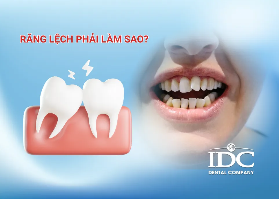 Răng lệch