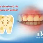 Răng xỉn màu