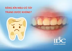 Răng khấp khểnh có ảnh hưởng đến sức khỏe răng miệng không?