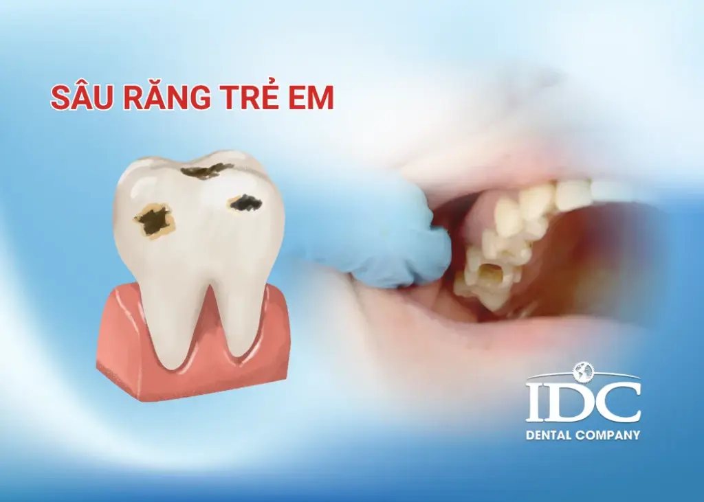 Sâu răng trẻ em