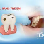 Sâu răng trẻ em