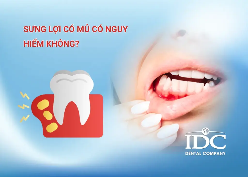 Sưng lợi có mủ có nguy hiểm không?
