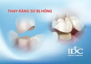 Có nên niềng răng sớm cho trẻ không? Thời điểm vàng cha mẹ cần biết