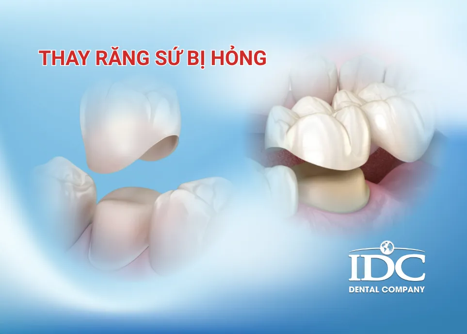 thay rang su bi hog