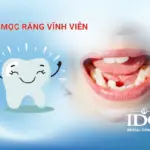 Trẻ mọc răng vĩnh viễn phụ huynh cần lưu ý những gì?