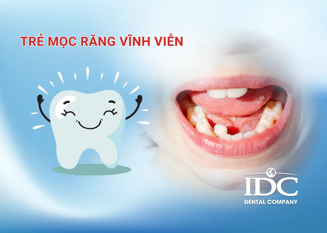 Trẻ mọc răng vĩnh viễn phụ huynh cần lưu ý những gì?