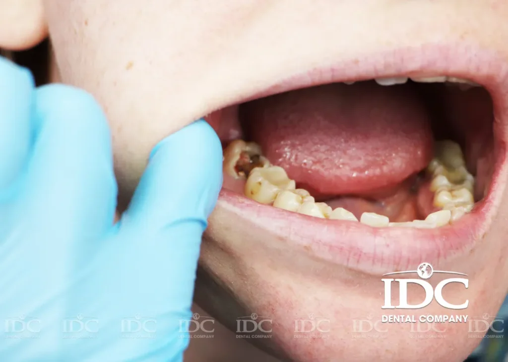 10 Ways to Manage and Treat Tooth Pain Caused by a Cavity