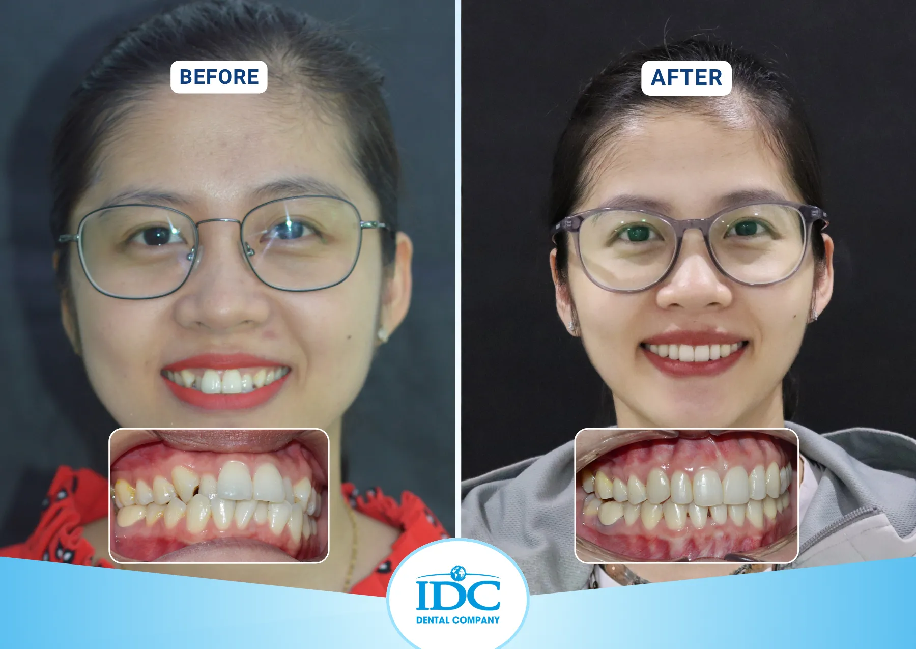 A Patient Orthodontic - Le Song Thuy
