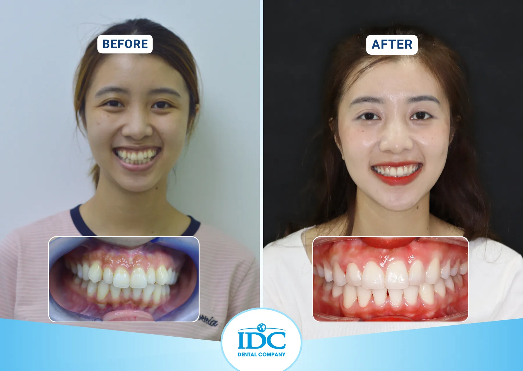 A Patient Orthodontic - Thanh Lan