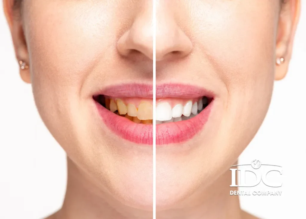 How Can You Whiten Yellow Teeth?