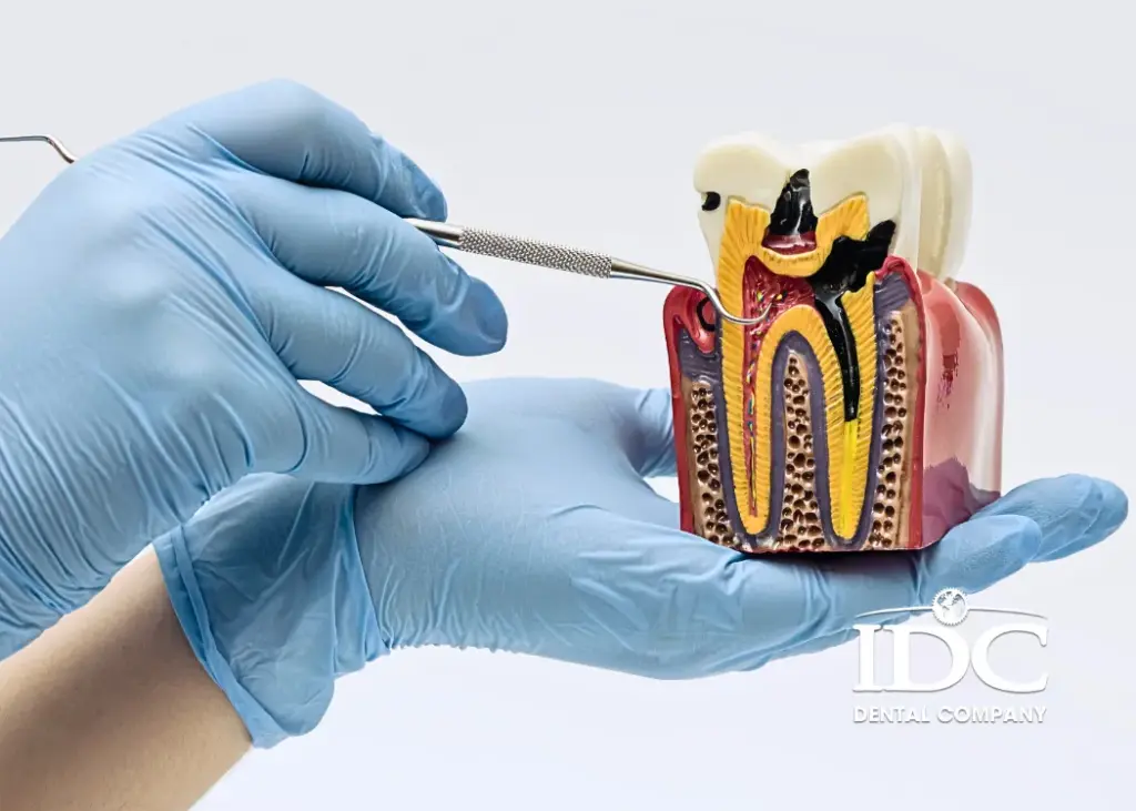 How to Treat Tooth Decay Effectively 1