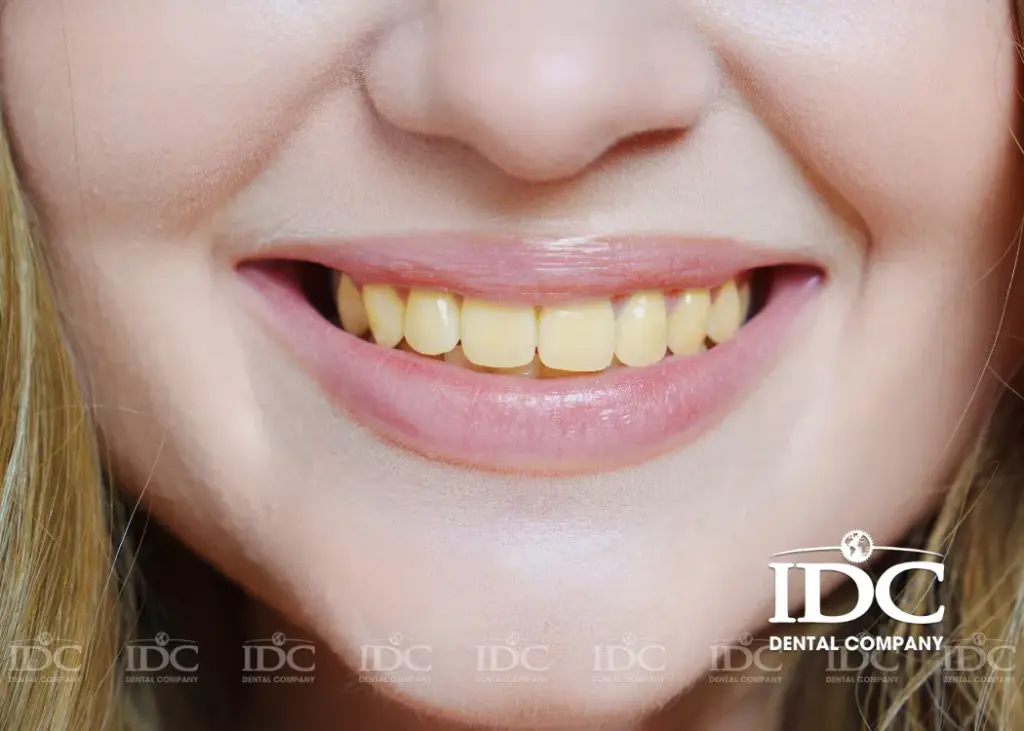 Surface Stains vs. Intrinsic Tooth Discoloration