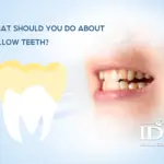 What should you do about yellow teeth?