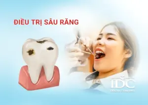 Bọc răng sứ bị vỡ có sửa được không? Cách xử lý và phòng ngừa hiệu quả