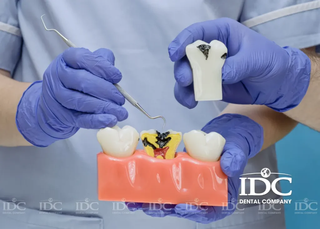 Sâu răng là gì? Vì sao cần điều trị sớm?