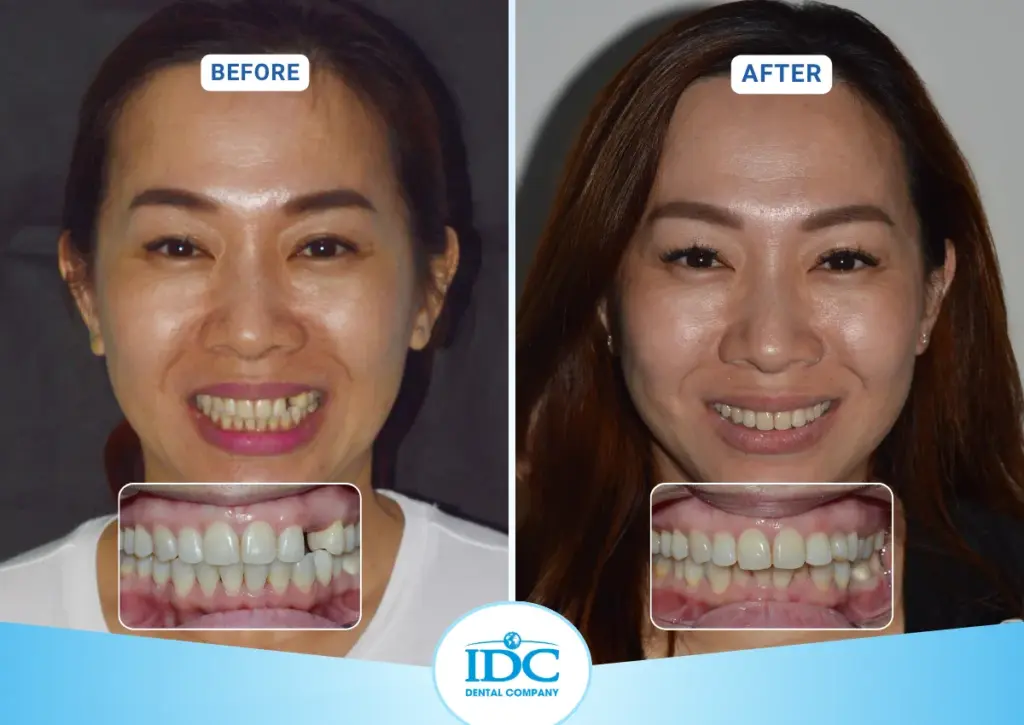 implant 1