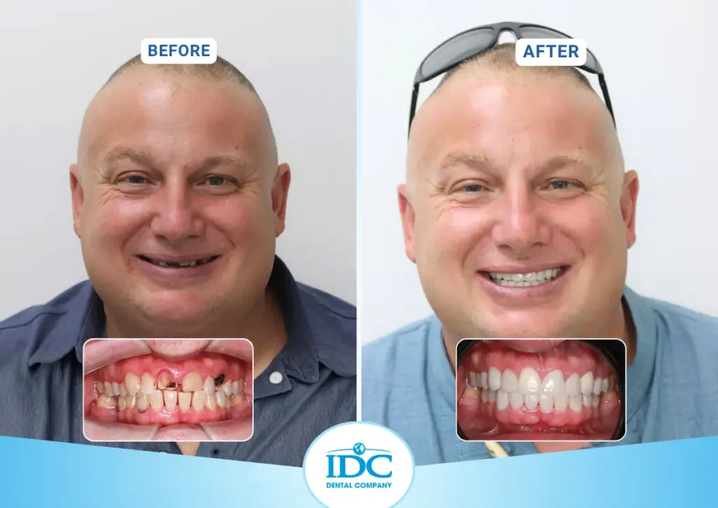 implant 2
