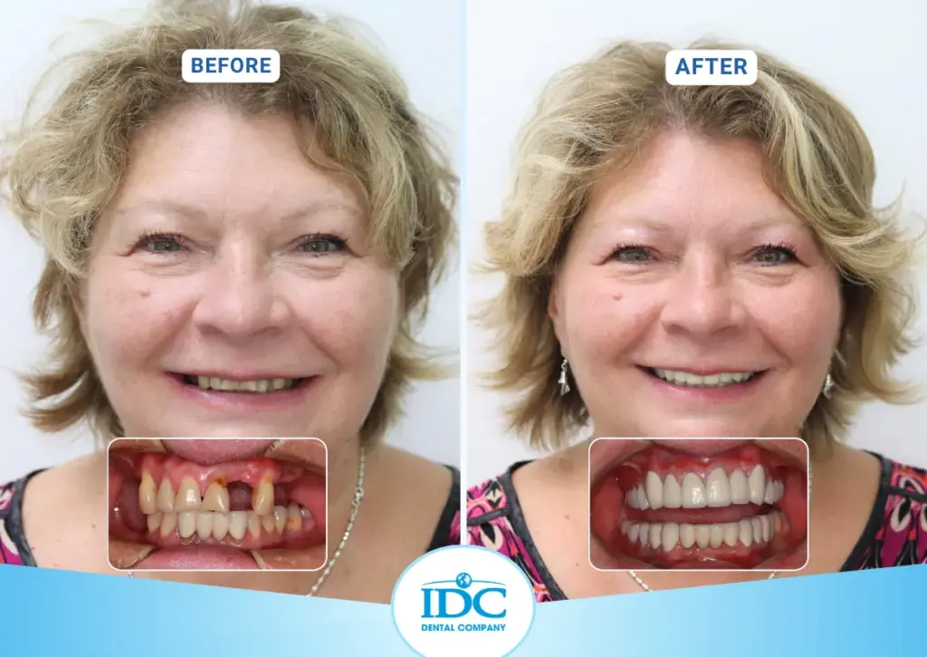implant 3