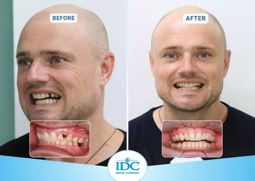 implant 4