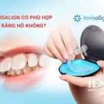 Invisalign có phù hợp với răng hô không?