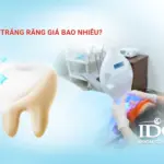 Làm trắng răng giá bao nhiêu?