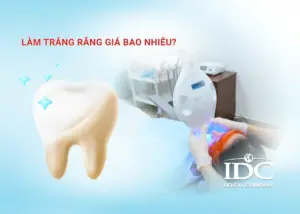 Làm trắng răng giá bao nhiêu?