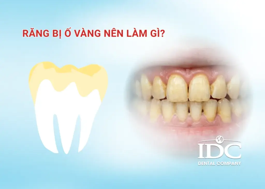 Răng bị ố vàng nên làm gì?