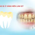 Răng bị ố vàng nên làm gì?