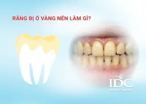 Đau răng khôn phải làm sao? Cách giảm đau an toàn tại nhà