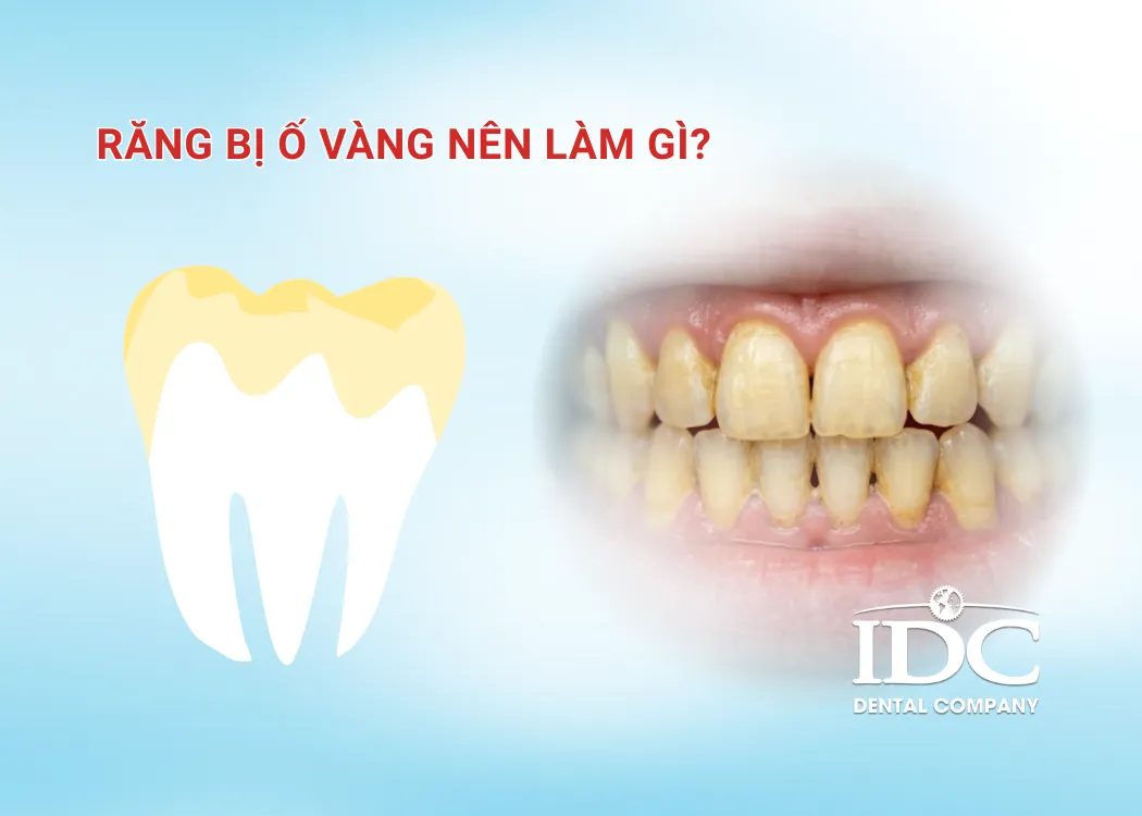 Răng bị ố vàng nên làm gì?
