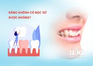 Bọc răng sứ có niềng răng được không? 5 Điều cần biết