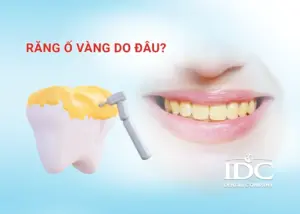 Làm răng sứ Cercon có tốt không? Giải đáp của chuyên gia