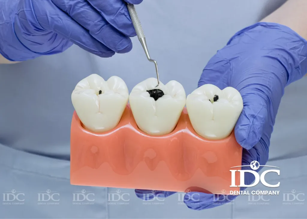 Các mức độ sâu răng và phương pháp điều trị phù hợp