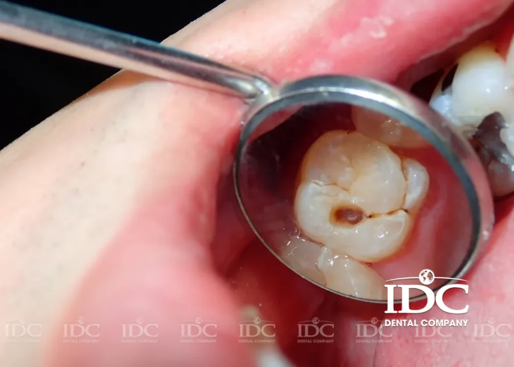 Dấu hiệu nhận biết răng bị sâu cần điều trị