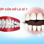 khớp căn hở là gì