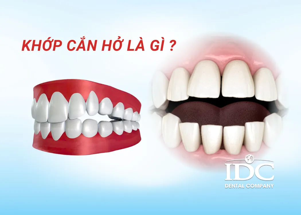 khớp căn hở là gì