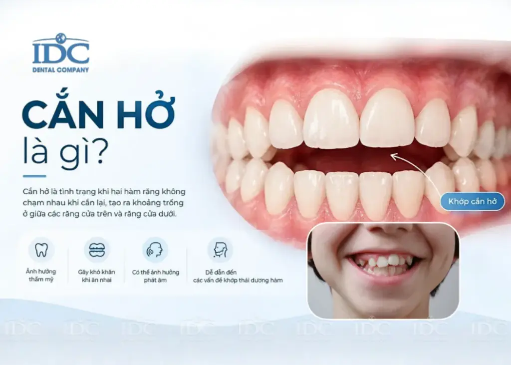 Khớp cắn hở 