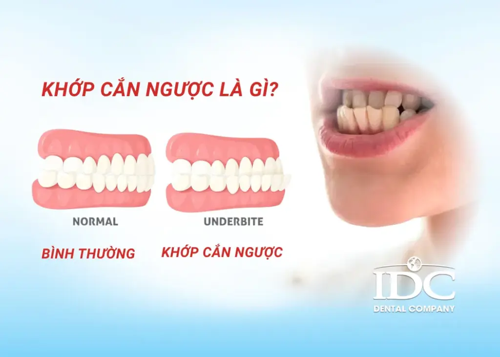Khớp cắn ngược là gì?