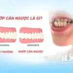 Khớp cắn ngược là gì?