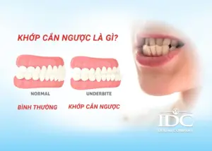 Bảng Giá Trồng Răng Implant Trọn Gói Tại Đà Nẵng Mới Nhất (2026)