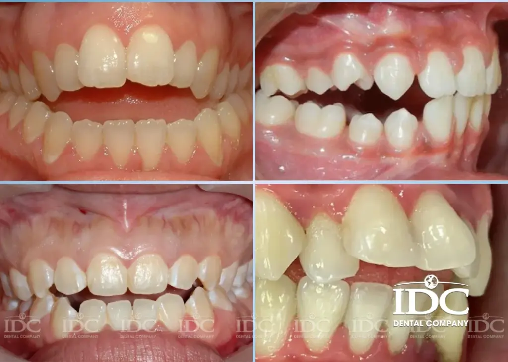 Những trường hợp khớp cắn hở