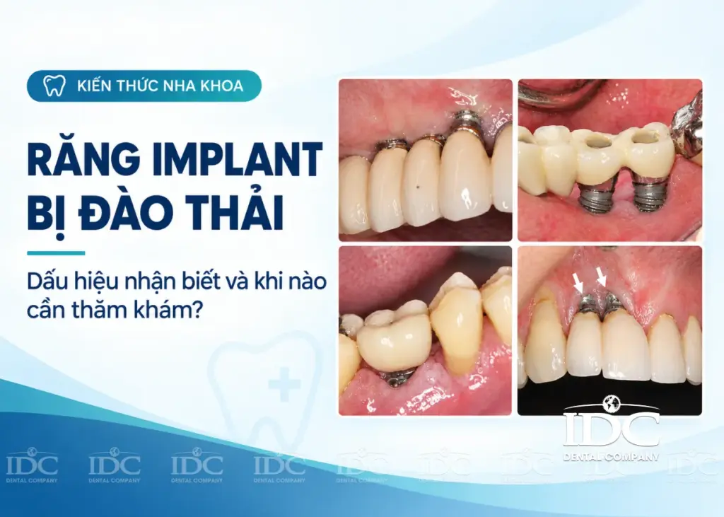 Răng implant bị đào thải